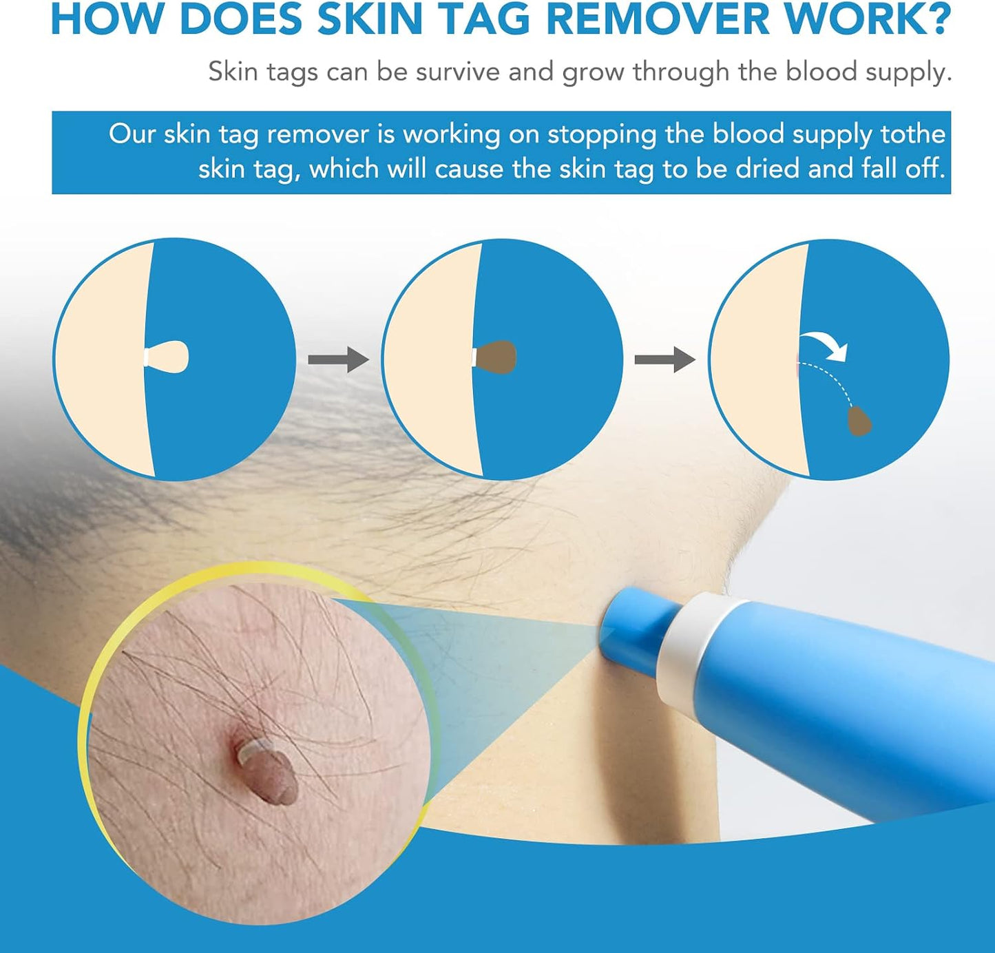 Skin Tag Remover Device Fda-Cleared Safe and Effective Skin Tag Removal Kits Home Use