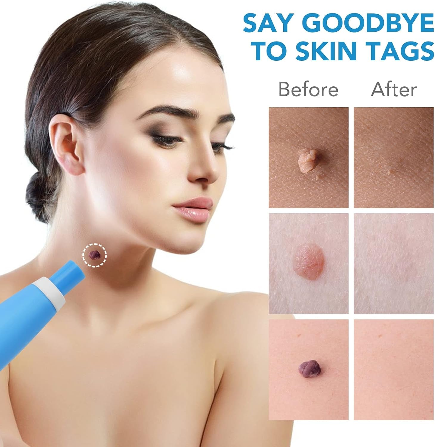 Skin Tag Remover Device Fda-Cleared Safe and Effective Skin Tag Removal Kits Home Use
